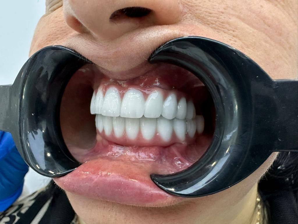 İMPLANT DENTAR ȘI FAȚETE