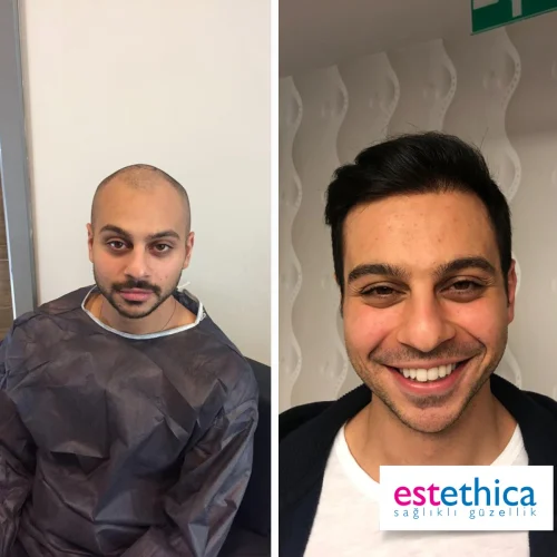 Sac-Ekim-Hair-Transplant-71 (1)