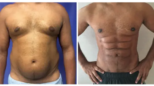 Six-Pack-Liposuction-6 (1)